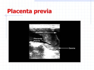 Placenta previa
 