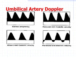 Umbilical Artery Doppler
 