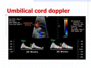 Umbilical cord doppler
 