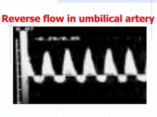 Reverse flow in umbilical artery
 