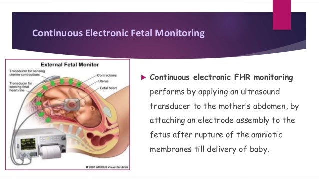 Types Of Fetal Monitoring