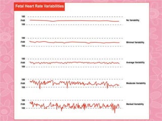 Variability Baby Chart fetal monitoring (2).ppt