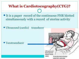 Fetal monitoring for undergraduate | PPT