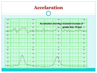 Fetal monitoring for undergraduate | PPT