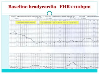 Baseline bradycardia FHR<110bpm
 