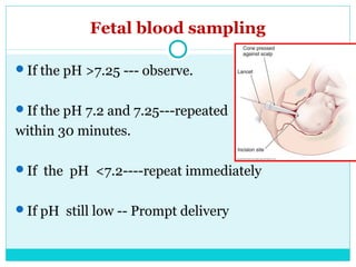 Fetal blood sampling
If the pH >7.25 --- observe.
If the pH 7.2 and 7.25---repeated
within 30 minutes.
If the pH <7.2--...