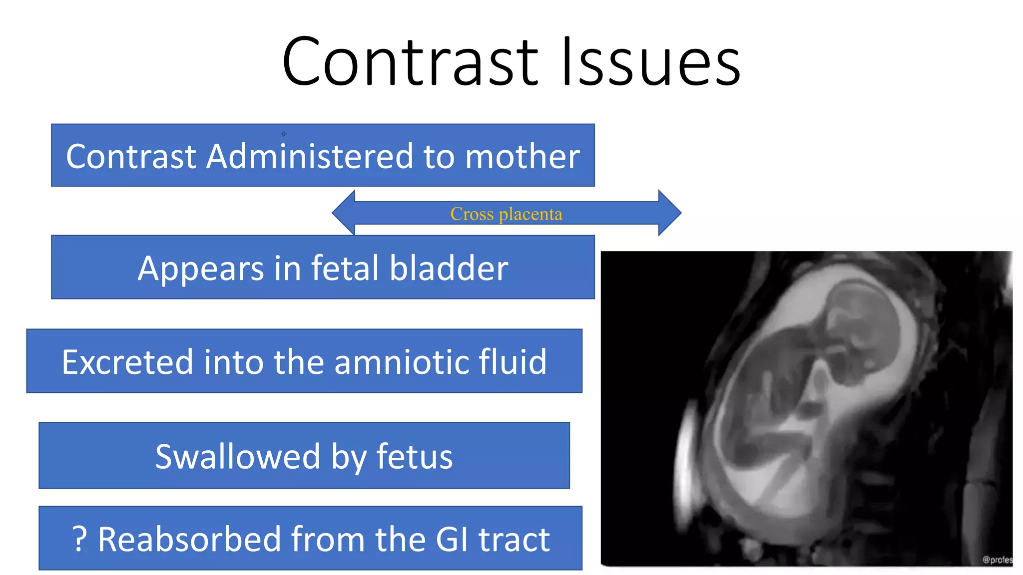 Contrast Issues
Contrast Administered to mother
Appears in fetal bladder
Excreted into the amniotic fluid
Swallowed by fetus
? Reabsorbed from the GI tract
Cross placenta
 