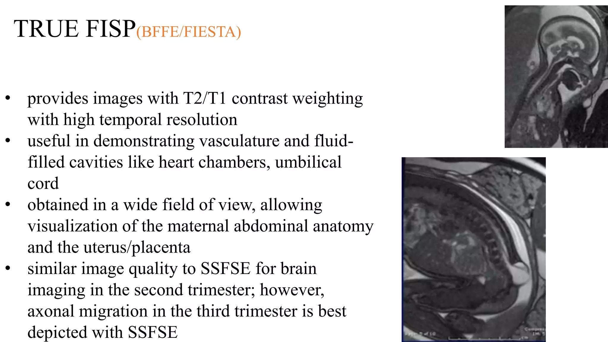 TRUE FISP(BFFE/FIESTA)
• provides images with T2/T1 contrast weighting
with high temporal resolution
• useful in demonstrating vasculature and fluid-
filled cavities like heart chambers, umbilical
cord
• obtained in a wide field of view, allowing
visualization of the maternal abdominal anatomy
and the uterus/placenta
• similar image quality to SSFSE for brain
imaging in the second trimester; however,
axonal migration in the third trimester is best
depicted with SSFSE
 