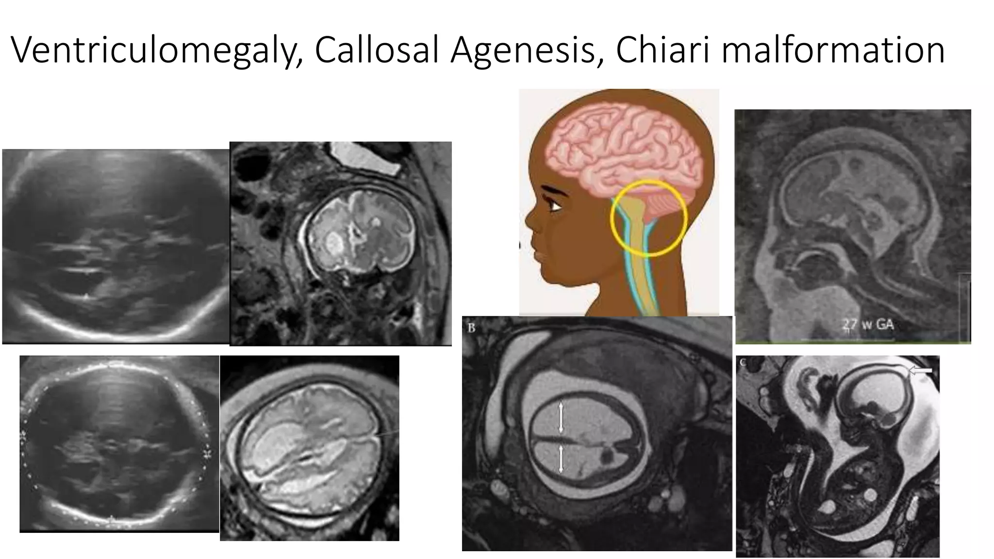Ventriculomegaly, Callosal Agenesis, Chiari malformation
 