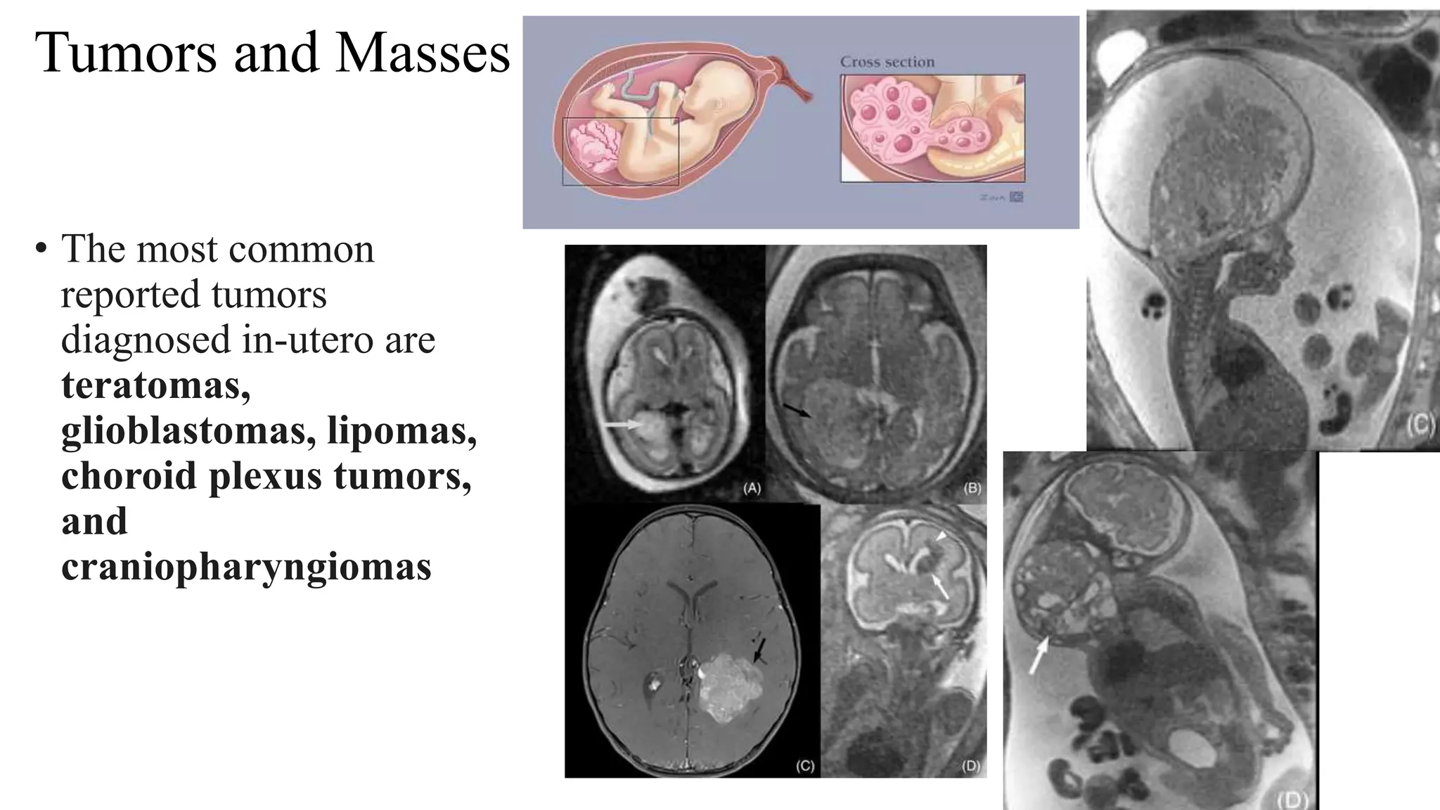 Tumors and Masses
• The most common
reported tumors
diagnosed in-utero are
teratomas,
glioblastomas, lipomas,
choroid plexus tumors,
and
craniopharyngiomas
 