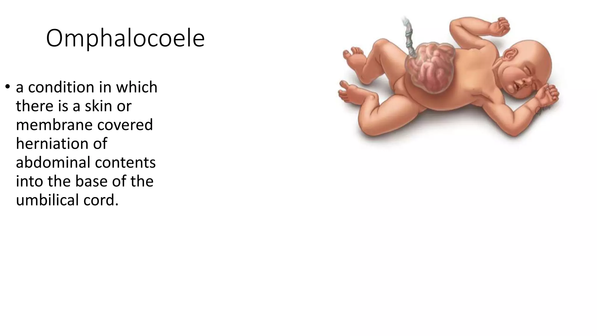 Omphalocoele
• a condition in which
there is a skin or
membrane covered
herniation of
abdominal contents
into the base of the
umbilical cord.
 