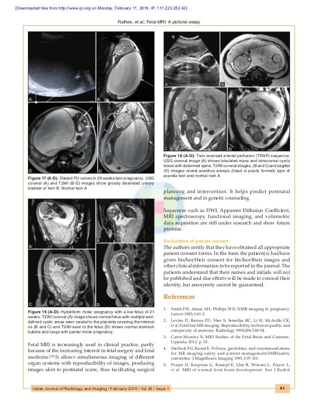 Normal fetal mri image
