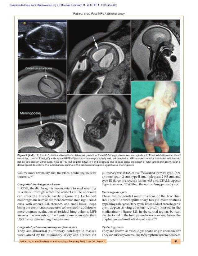 Fetal brain abnormality image