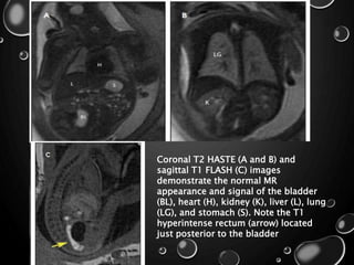 Coronal T2 HASTE (A and B) and
sagittal T1 FLASH (C) images
demonstrate the normal MR
appearance and signal of the bladder
(BL), heart (H), kidney (K), liver (L), lung
(LG), and stomach (S). Note the T1
hyperintense rectum (arrow) located
just posterior to the bladder
 