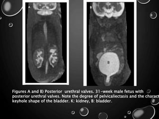 Figures A and B) Posterior urethral valves. 31-week male fetus with
posterior urethral valves. Note the degree of pelvicaliectasis and the charact
keyhole shape of the bladder. K: kidney, B: bladder.
 