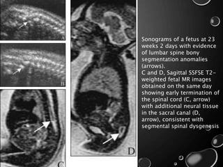 Sonograms of a fetus at 23
weeks 2 days with evidence
of lumbar spine bony
segmentation anomalies
(arrows).
C and D, Sagittal SSFSE T2-
weighted fetal MR images
obtained on the same day
showing early termination of
the spinal cord (C, arrow)
with additional neural tissue
in the sacral canal (D,
arrow), consistent with
segmental spinal dysgenesis
 