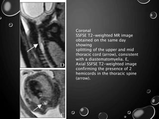 Coronal
SSFSE T2-weighted MR image
obtained on the same day
showing
splitting of the upper and mid
thoracic cord (arrow), consistent
with a diastematomyelia. E,
Axial SSFSE T2-weighted image
confirming the presence of 2
hemicords in the thoracic spine
(arrow).
 