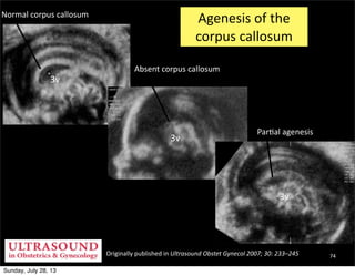 Originally	
  published	
  in	
  Ultrasound	
  Obstet	
  Gynecol	
  2007;	
  30:	
  233–245
3v
Normal	
  corpus	
  callosu...