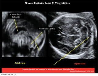 Normal	
  Posterior	
  Fossa	
  At	
  Midgesta=on
SagiGal	
  viewAxial view
Cavum	
  Sep,	
  
Pellucidi
Cerebellar	
  verm...