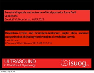 77
Prenatal	
  diagnosis	
  and	
  outcome	
  of	
  fetal	
  posterior	
  fossa	
  ﬂuid	
  
Collec=ons
Gandolﬁ	
  Colleoni...