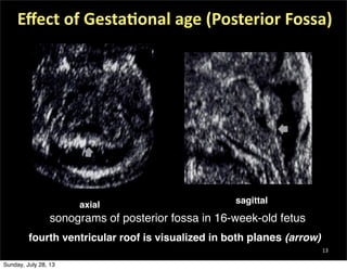sagittalaxial
sonograms of posterior fossa in 16-week-old fetus
13
of posterior fossa in 13- to 14-week-old fetus. called ...