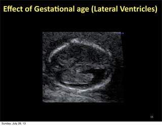 15
Eﬀect	
  of	
  Gesta=onal	
  age	
  (Lateral	
  Ventricles)
Sunday, July 28, 13
 