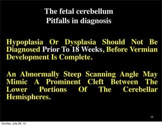 16
Hypoplasia Or Dysplasia Should Not Be
Diagnosed Prior To 18 Weeks, Before Vermian
Development Is Complete.
An Abnormall...