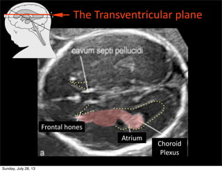 The	
  Transventricular	
  plane
Frontal	
  hones
Choroid	
  
Plexus
Atrium
Sunday, July 28, 13
 