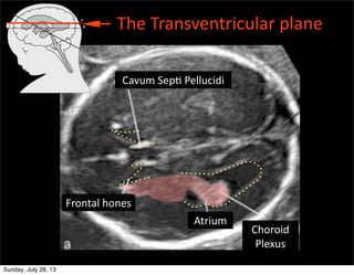 The	
  Transventricular	
  plane
Cavum	
  SepE	
  Pellucidi
Frontal	
  hones
Choroid	
  
Plexus
Atrium
Sunday, July 28, 13
 