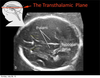 The	
  Transthalamic	
  	
  Plane
Sunday, July 28, 13
 