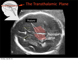 Thalami
The	
  Transthalamic	
  	
  Plane
Sunday, July 28, 13
 