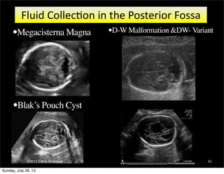 41
Fluid	
  Collec,on	
  in	
  the	
  Posterior	
  Fossa
•Blak’s Pouch Cyst
•Megacisterna Magna •D-W Malformation &DW- Var...