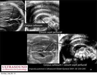 Originally	
  published	
  in	
  Ultrasound Obstet Gynecol 2007; 30: 233–245
midline
midline
Corpus	
  callosum
Cavum	
  s...