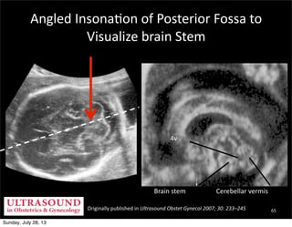 Originally	
  published	
  in	
  Ultrasound	
  Obstet	
  Gynecol	
  2007;	
  30:	
  233–245
4v
Brain	
  stem Cerebellar	
 ...
