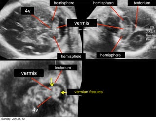 Originally published in Ultrasound Obstet Gynecol 2007; 30: 233–245
4v
hemisphere
hemisphere
hemisphere
hemisphere
vermis
...