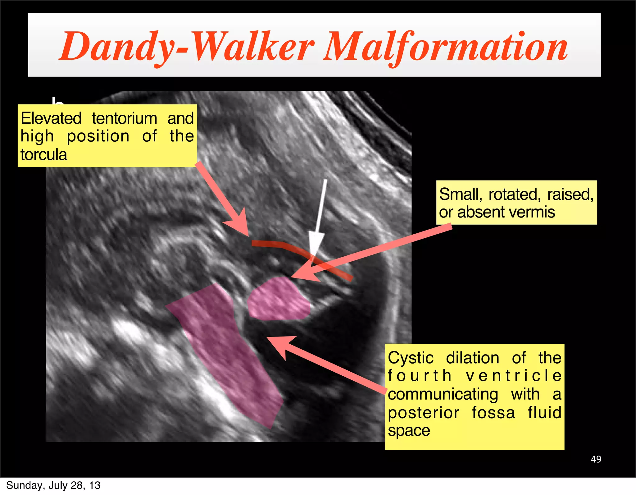 Fetal Neurosonogram | PDF