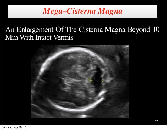 What is a mega cisterna magna?