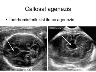 Callosal agenezis İnetrhemisferik kist ile cc agenezis 