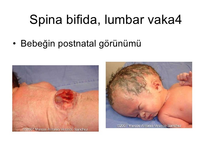 FETAL NÖROSONOGRAFİ