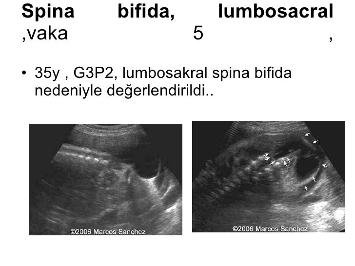 FETAL NÖROSONOGRAFİ