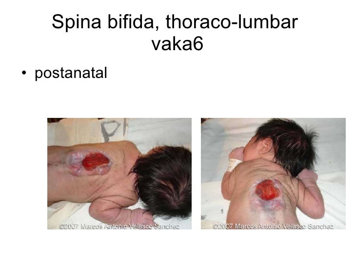 FETAL NÖROSONOGRAFİ