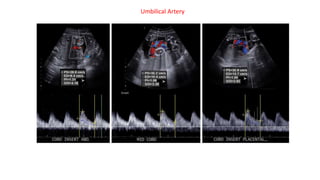 Umbilical Artery
 