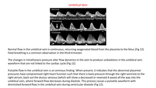 Normal flow in the umbilical vein is continuous, returning oxygenated blood from the placenta to the fetus (Fig 12).
Fetal breathing is a common observation in the third trimester.
The changes in intrathoracic pressure alter flow dynamics in the vein to produce undulations in the umbilical vein
waveform that are not linked to the cardiac cycle (Fig 12).
Pulsatile flow in the umbilical vein is an ominous finding. When present, it indicates that the abnormal placental
pressures have compromised right heart function such that there is back pressure through the right ventricle to the
right atrium, back out the ductus venosus (which will show a decreased or reversed A wave) all the way into the
umbilical vein, where forward flow decreases during diastole. This process causes a pulsatile waveform with
diminished forward flow in the umbilical vein during ventricular diastole (Fig 12).
Umbilical Vein
 