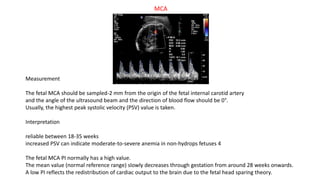 Middle Cerebral Artery
Fetal Doppler US of the middle cerebral artery is used in two situations:
(a) Non invasive assessme...