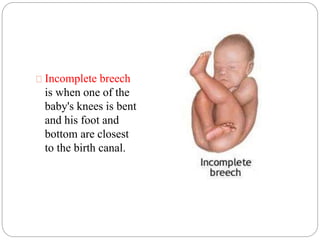 Incomplete breech 
is when one of the 
baby's knees is bent 
and his foot and 
bottom are closest 
to the birth canal. 
 