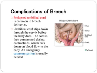 Complications of Breech 
Prolapsed umbilical cord 
is common in breech 
deliveries. 
Umbilical cord slips down 
through the cervix before 
the baby does. The cord is 
then compressed during 
contractions, which cuts 
down on blood flow to the 
baby. An emergency 
cesarean section is usually 
needed. 
 