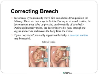 Correcting Breech 
doctor may try to manually move him into a head-down position for 
delivery. There are two ways to do this: During an external version, the 
doctor moves your baby by pressing on the outside of your belly. 
During an internal version, the doctor inserts his hand through the 
vagina and cervix and moves the baby from the inside. 
If your doctor can't manually reposition the baby, a cesarean section 
may be needed. 
 