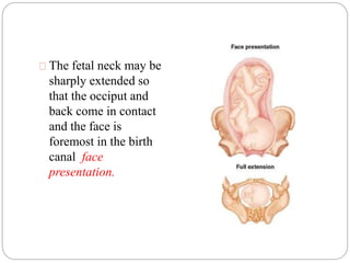 The fetal neck may be 
sharply extended so 
that the occiput and 
back come in contact 
and the face is 
foremost in the birth 
canal face 
presentation. 
 