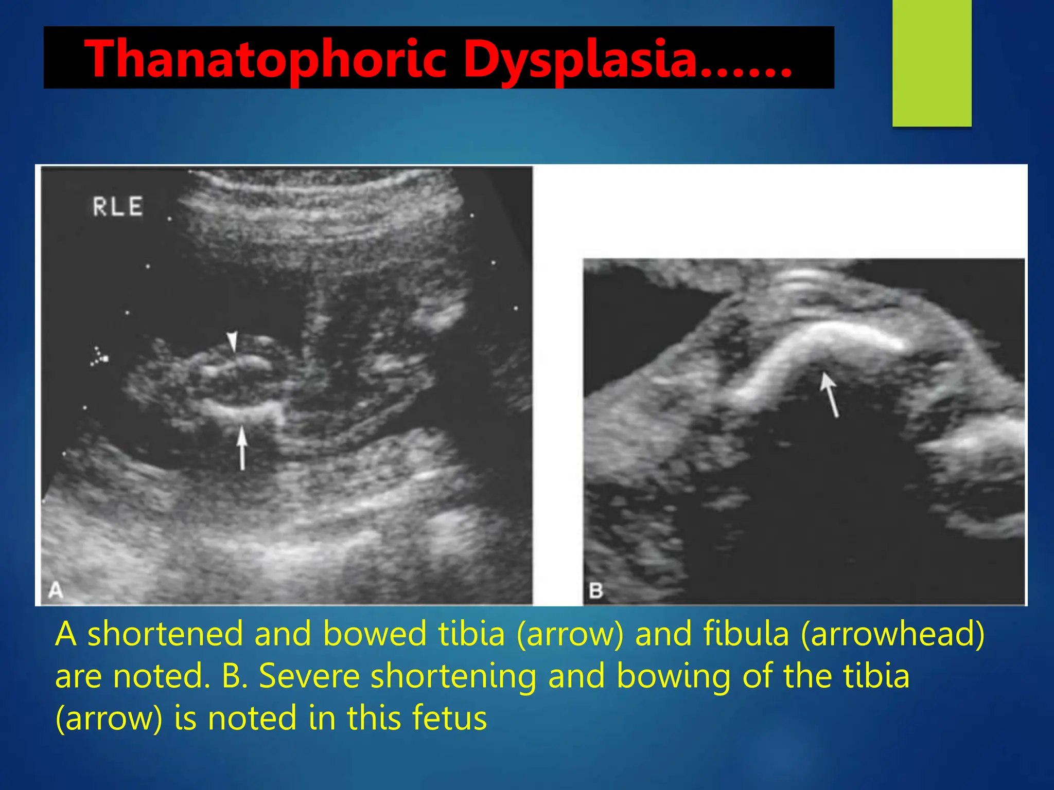 FETAL SKELETAL ANOMALIES GROUP 3.pptx