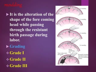 Positional Molding Fetal Skull obstetrics and gynecological | PPTX